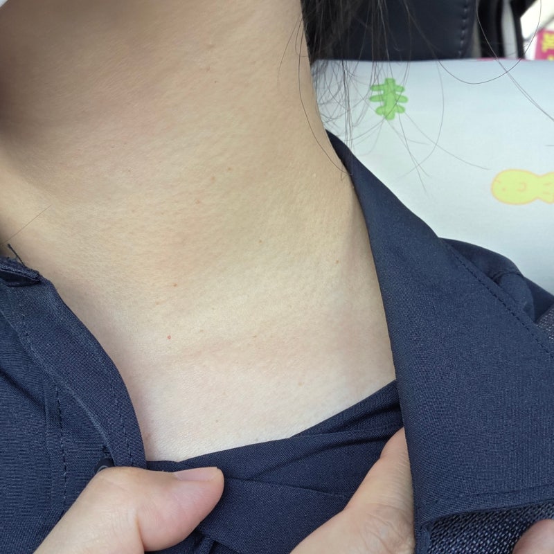 부산편평사마귀 부산쥐젖제거한의원 관리편한 얼굴 목 무제한 솔직후기