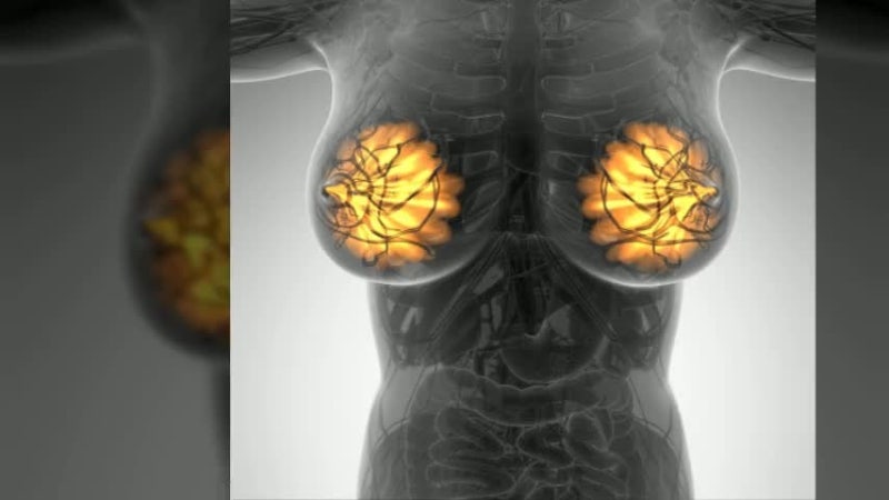 유방암 초기증상, 멍울 없어도 놓치면 안 되는 변화 총정리