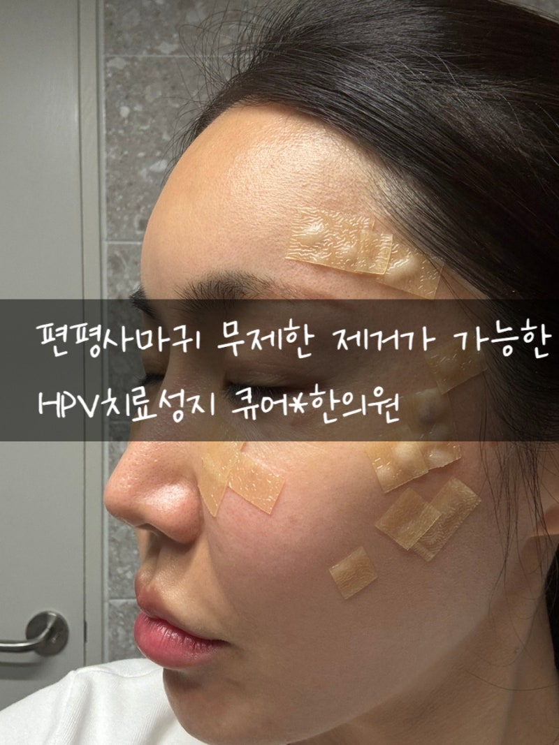 강남역 얼굴 편평사마귀 무제한 제거 후기 강남 HPV치료 성지 한의원