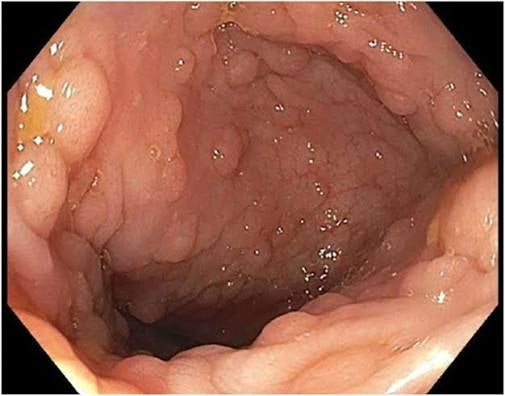 대장 용종이 생기는 5가지 원인 (Major causes of colon polyps)