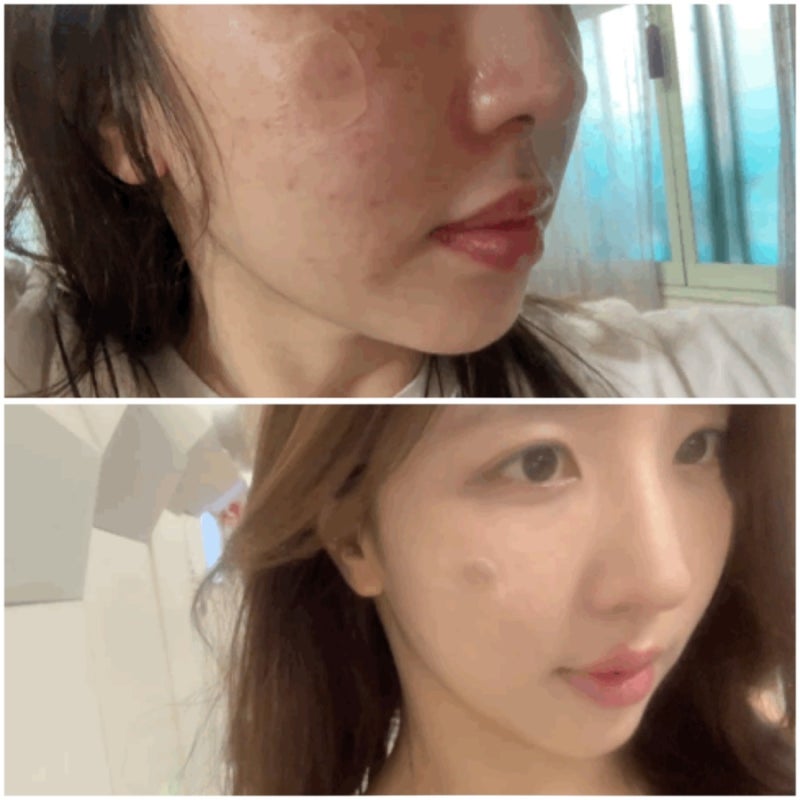 [7탄] 내 돈 내산 피코토닝 + 흑자 제거 2주 경과 리얼 후기 : "이런 사람이 피코토닝 받으면 좋....