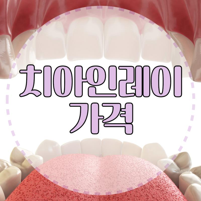 충치 치료할 때 레진과 지르코니아 인레이의 가격 차이와 재료별 장단점은?