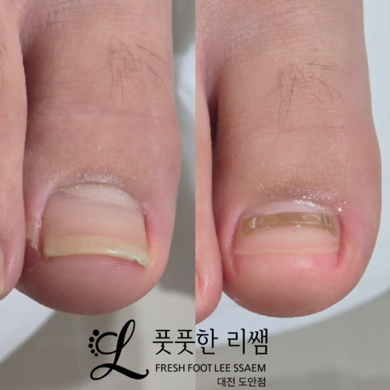 도안동내성발톱관리 문제성발관리전문샵추천 - 풋풋한리쌤 대전도안점 | 도안동발관리 도안....