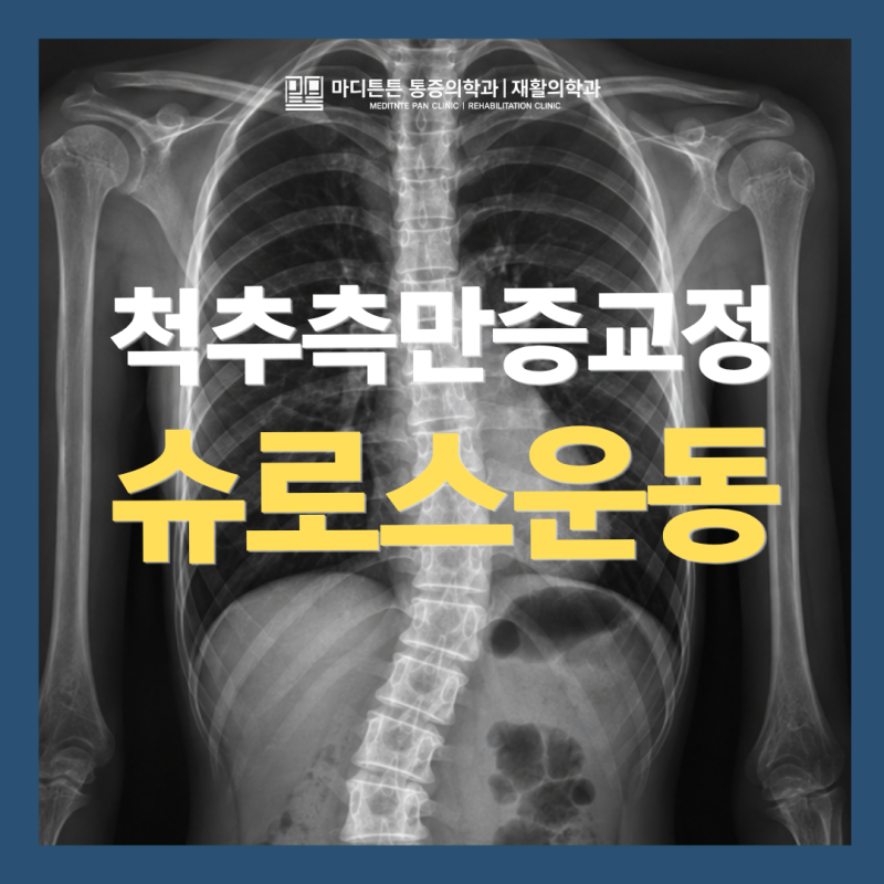 광주 슈로스운동이란? 척추측만증이라면 알아두세요