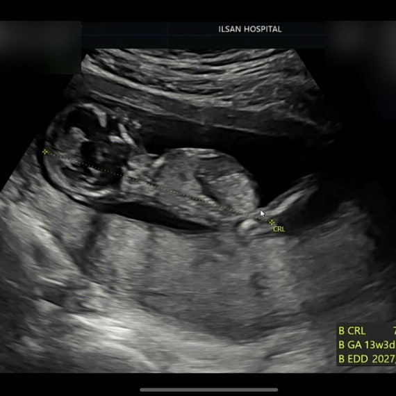 [임신 12주 5일] 쌍둥이 일산병원 니프티 검사 + 1차 기형아 검사, 아스피린, 마미렉틴 입덧약, ....