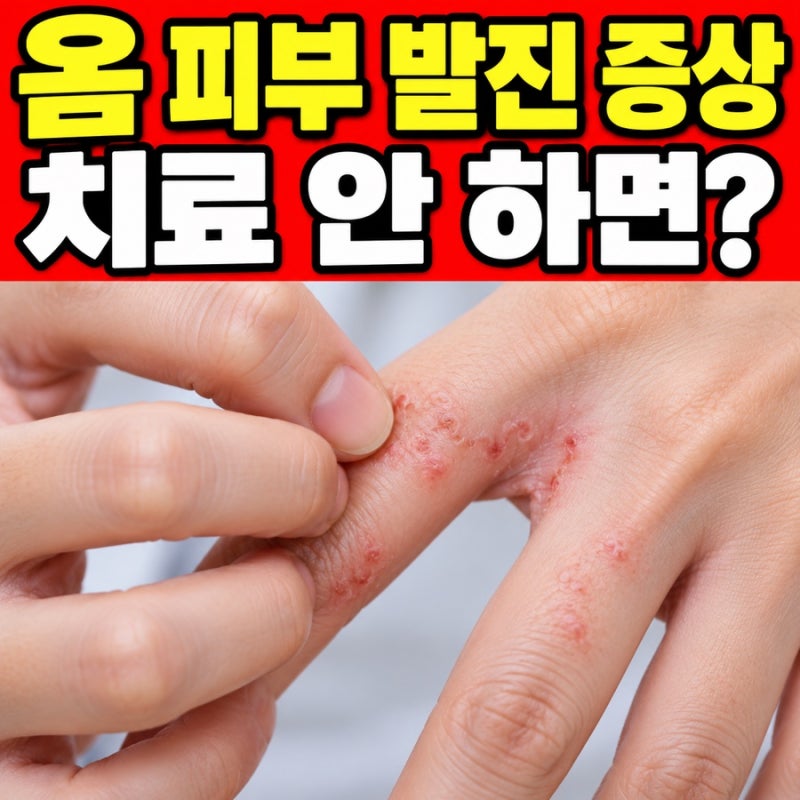 옴 피부 발진 증상 치료 안 하면?