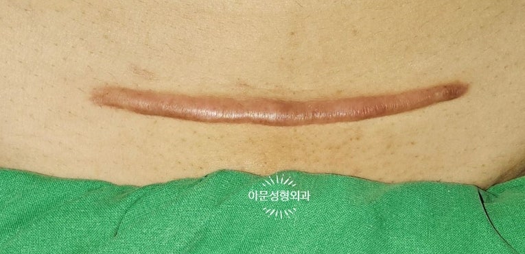 제왕절개 켈로이드 치료법 총정리 (서울 강동구 아문성형외과) 주사 수술 레이저