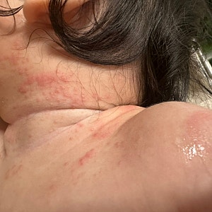 아기 침독 관리, 2차 영유아검진에서 스테로이드 연고 처방받고 3일 후 변화
