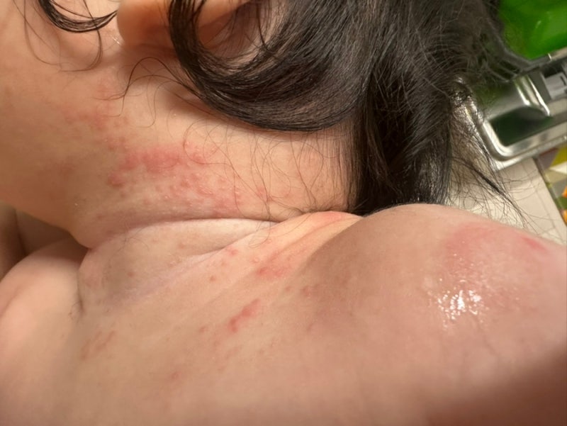 아기 침독 관리, 2차 영유아검진에서 스테로이드 연고 처방받고 3일 후 변화