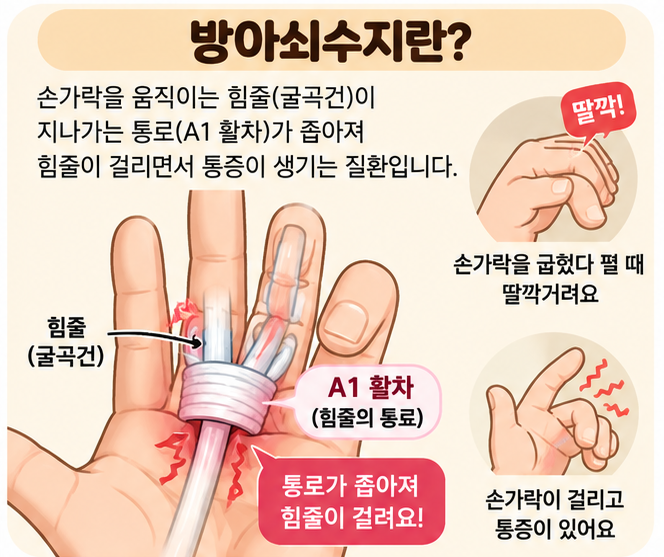 주사치료 후에도 손가락 통증, 남양주 방아쇠수지 수술