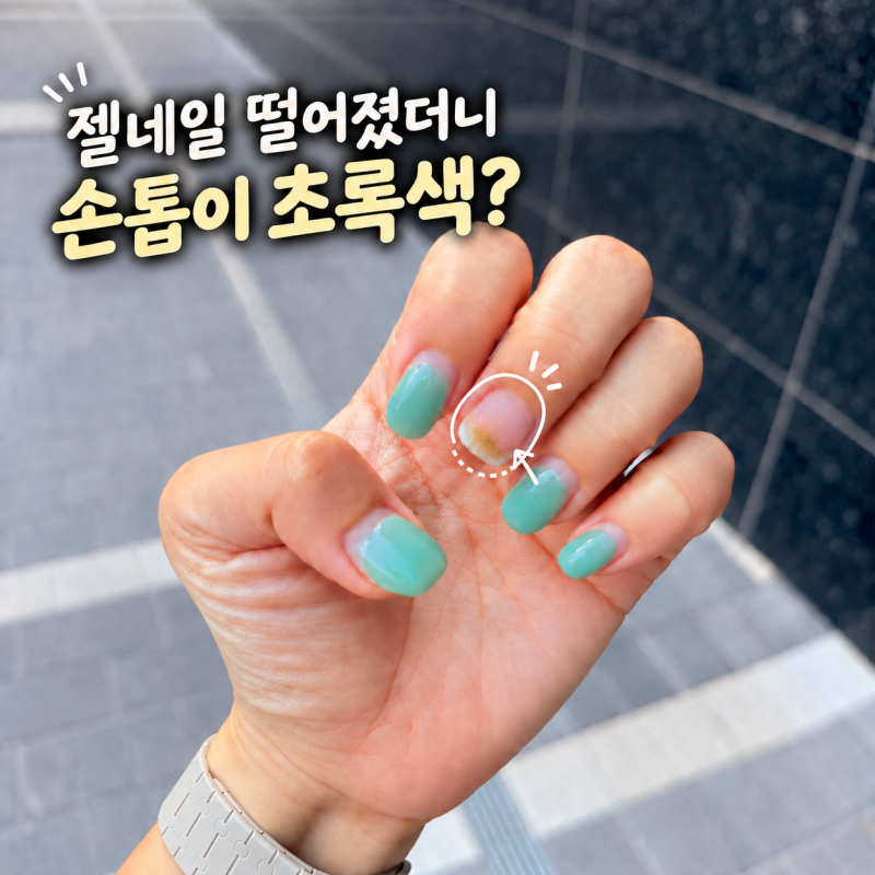 젤네일 떨어지고 손톱이 초록색, 그린네일일까?