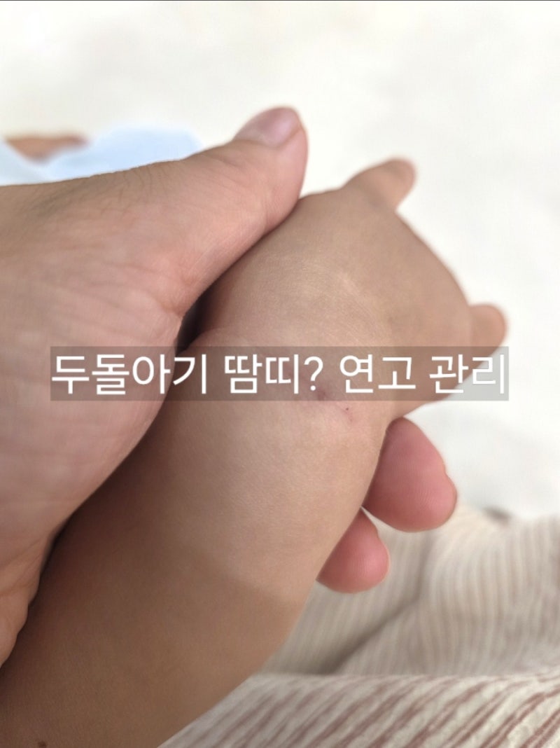 두돌 아기 땀띠 손목에 빨갛게 올라왔어요, 증상부터 연고·관리까지