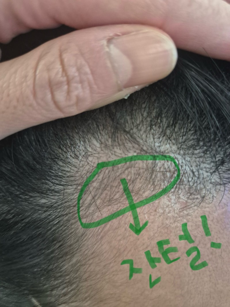 [내돈내산] 남편이 먹은 먹는 탈모약 솔직 후기! 부부동반 발랐던 바르는 마이녹실·로게인 ....