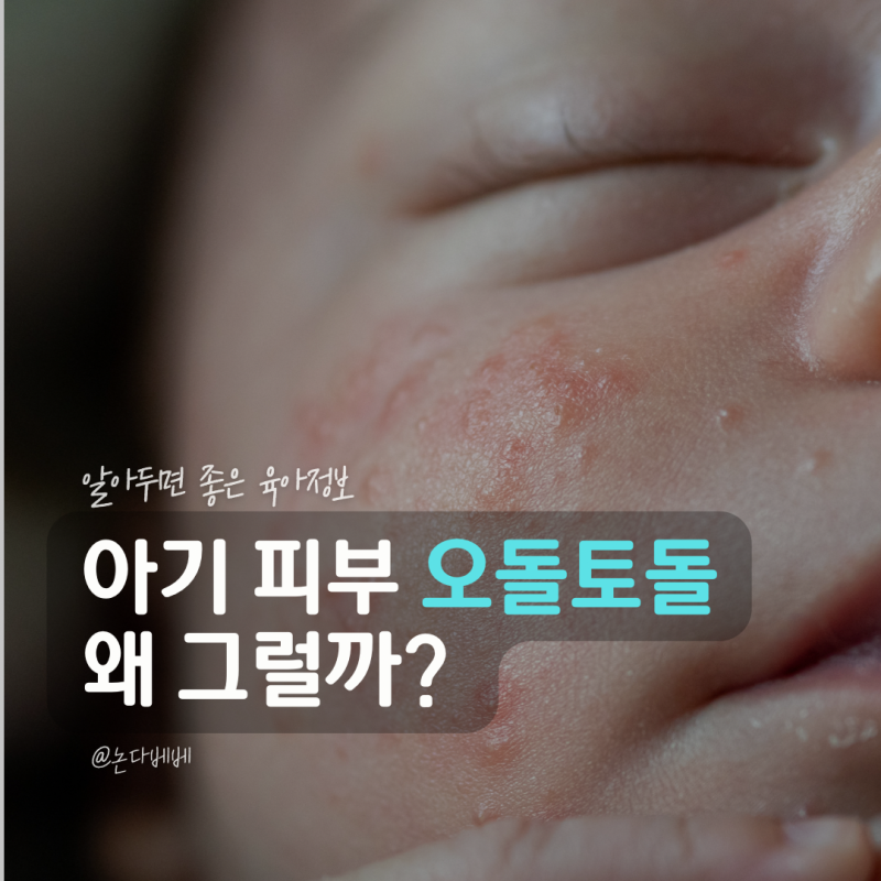 아기 피부 오돌토돌 원인 뭘까? 태열 땀띠 아토피 좁쌀 여드름 구분법