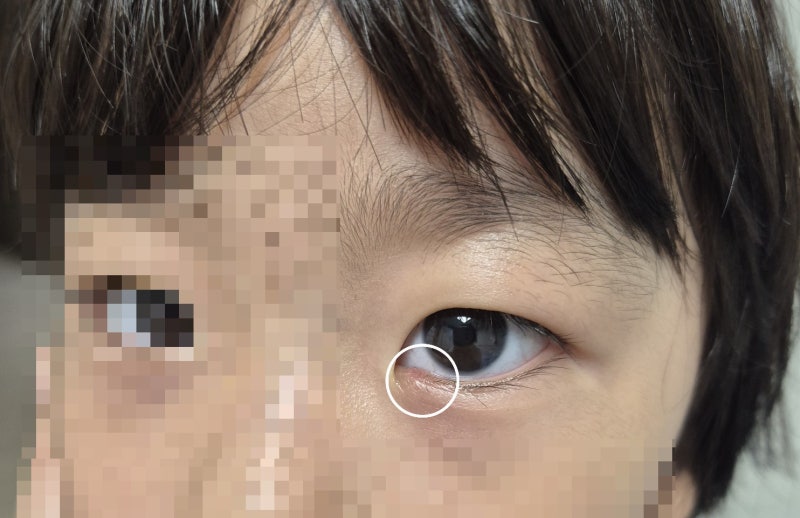 눈다래끼(콩다래끼) 4주째… │ 42개월 아기, 다시 안과에 다녀왔어요