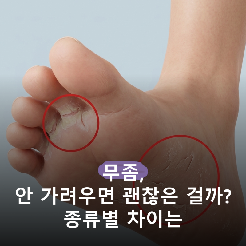 발바닥 각질인 줄 알았는데 무좀이었다?.. 무좀 종류 3가지와 가렵지 않은 무좀이 더 오래 가....