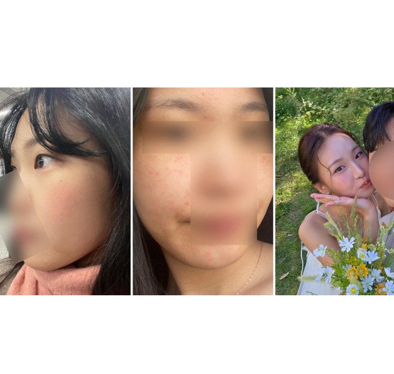 나의 4년간 주사피부염 치료 및 호전 이야기, 효과 있던 기초제품 추천, 사용했던 연고&약 기....