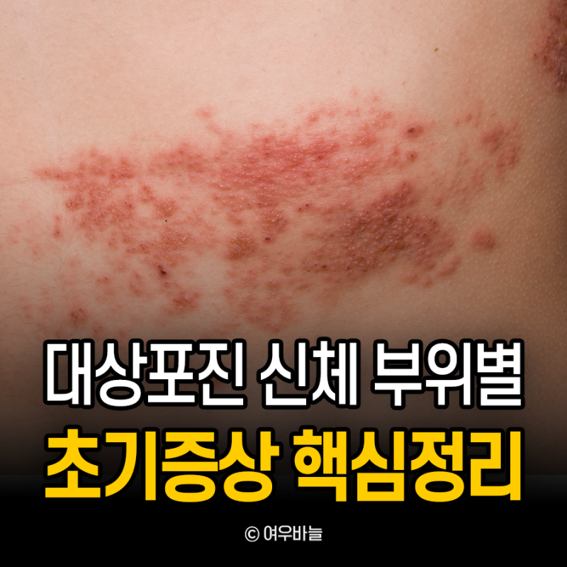 대상포진 원인 및 초기증상 총정리(+얼굴·두피·가슴·배·허벅지 부위별 증상)