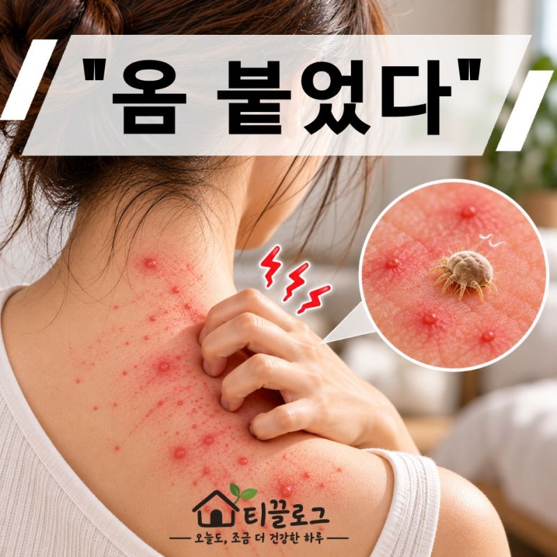 "옴 붙었다" 옛날 피부병인 줄 알았는데… 지금도 가족끼리 옮을 수 있다