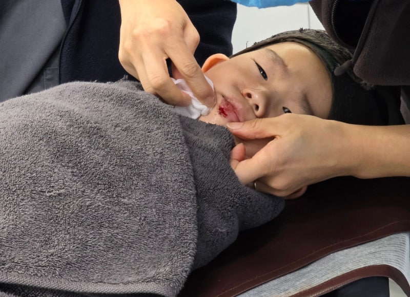 33개월 아기 입술 찢어짐 봉합수술 후기｜추석 당일 소아 성형외과 찾은 과정