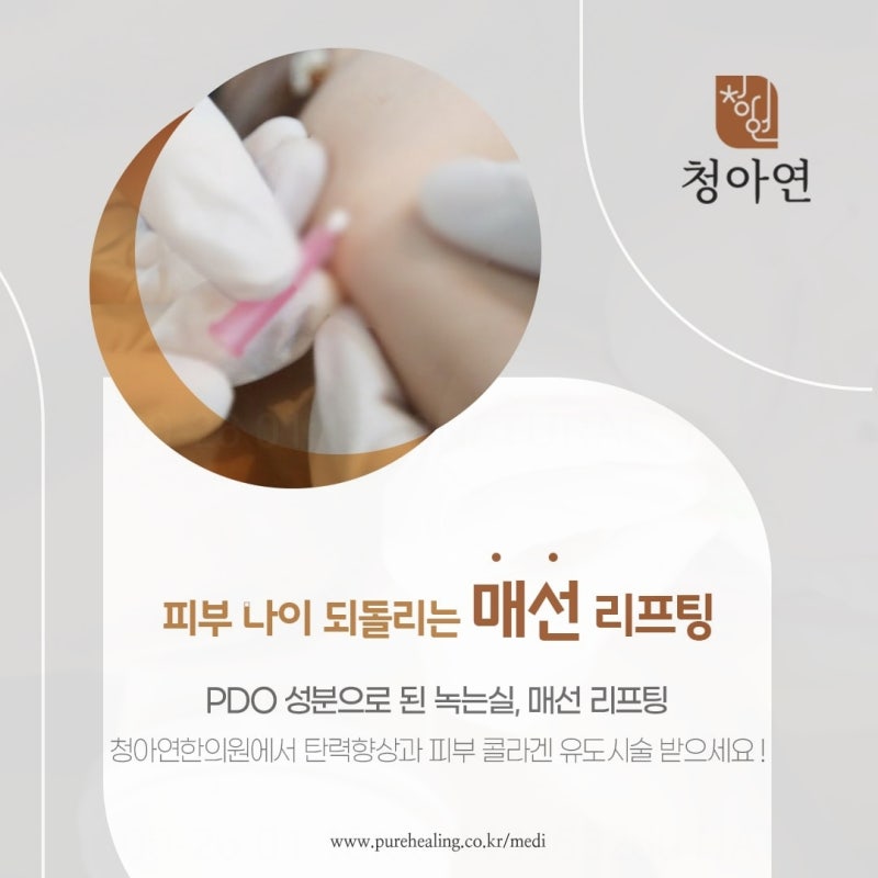 아이홀꺼짐 눈꺼풀처짐 증상 눈가 실리프팅으로 해결