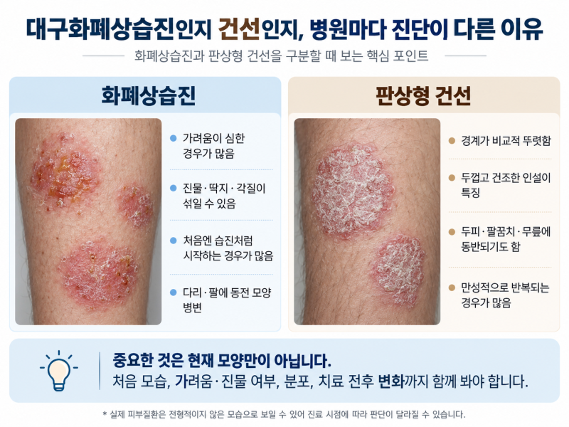 대구화폐상습진인지 건선인지, 병원마다 진단이 다른 이유