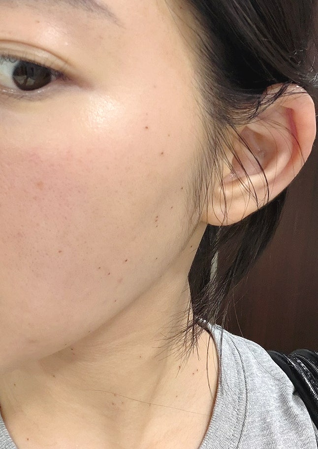 분당편평사마귀제거무제한 제거 솔직후기 : 제거 직후부터 7일차까지 변화
