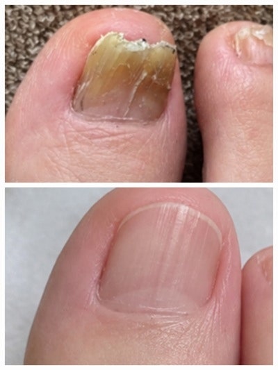 발톱무좀 치료 재발 없으려면 보세요_연고 약 사용법까지