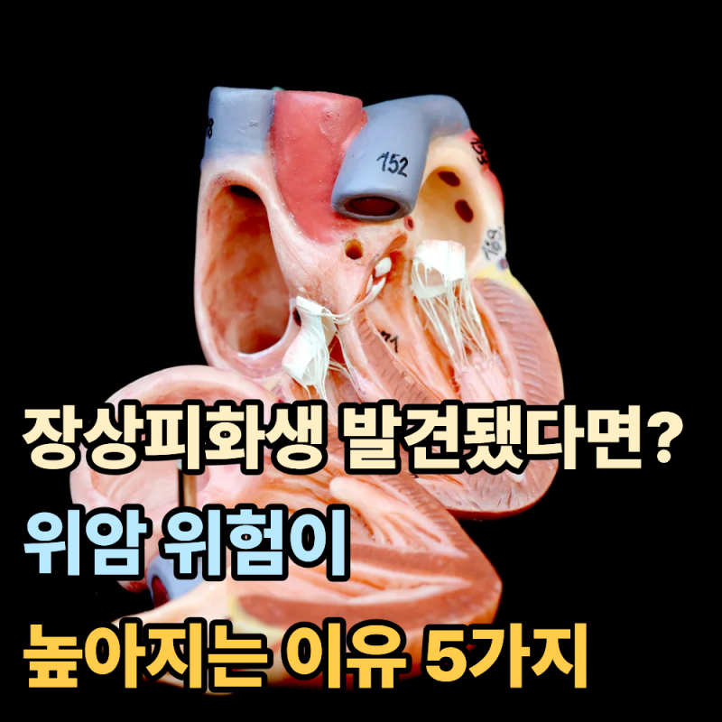 "장상피화생 발견됐다면?"...위암 위험이 높아지는 이유 5가지