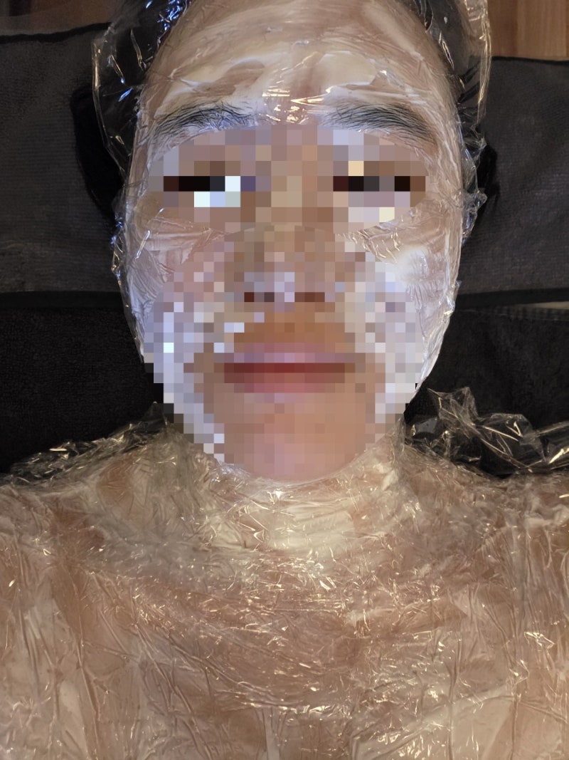 대전 하늘체한의원 편평사마귀 제거 후기