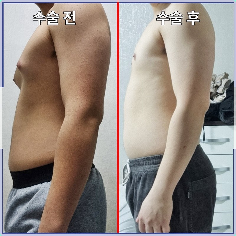 여성형유방증보험 강남에서 수술 전이라면 실비 보장부터 확인하세요 [Dr.디에이 여유증]