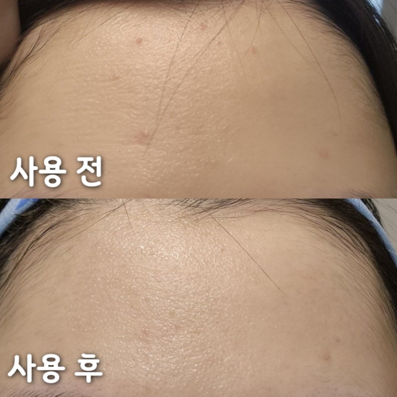 좁쌀여드름엔 무조건 브링그린 알로에팩! 일주일동안 써 본 내돈내산 후기