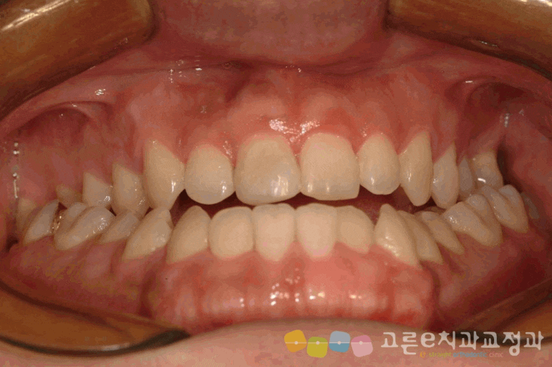 골격성 III급 부정교합 ( AKA, 주걱턱 ) - 양악 수술 교정 치료 케이스 / 은평구 치아 교정