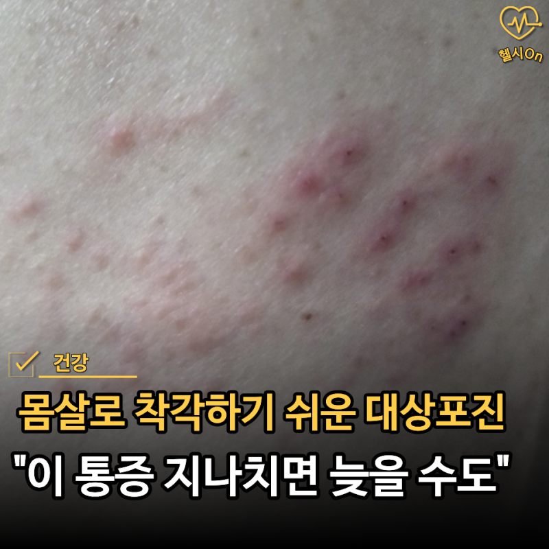 "몸살인 줄 알았는데 피부가 따끔.." 감기와 헷갈려 놓치기 쉬운 대상포진 초기증상 5가지