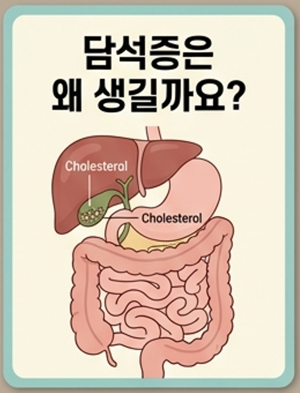 방치하면 치명적인 합병증을 부르는 담석증