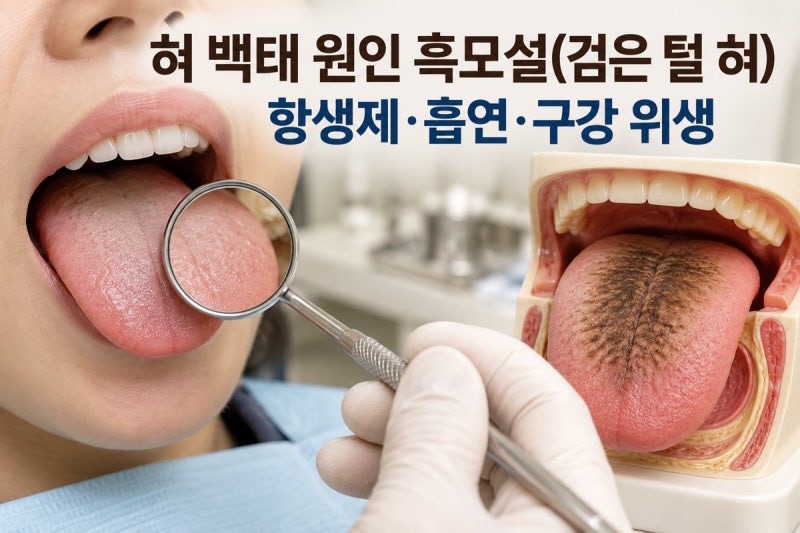 혀 백태 원인 흑모설(검은 털 혀): 과도한 항생제 흡연 불량한 구강 위생