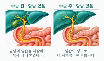 [담석증과 담낭제거술] 갑자기 찾아온 극심한 통증, 그리고 담석증 진단