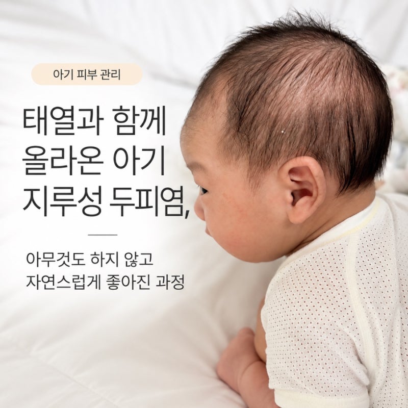 태열과 함께 올라온 아기 지루성 두피염, 아무것도 하지 않고 자연스럽게 좋아진 과정