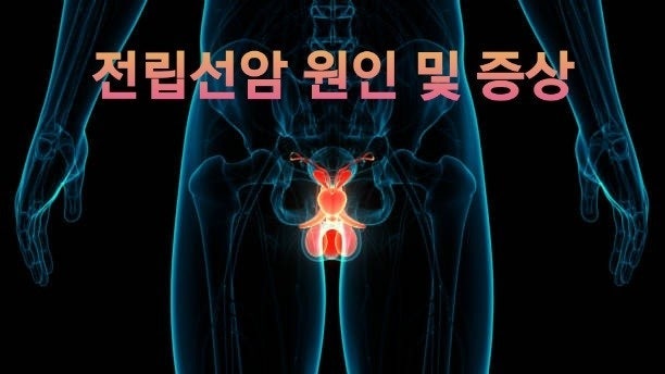 "남성암 발생 1위 전립선암"… 조기에 잡지 못해 '전이'되면 생존율 절반으로 뚝?