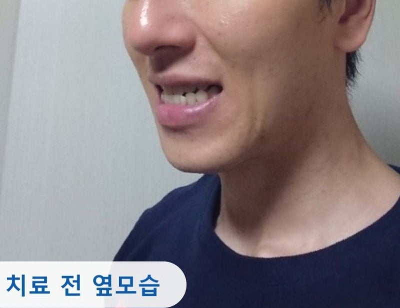 "양악밖에 없다"던 주걱턱, 비수술 교정 1년 후?