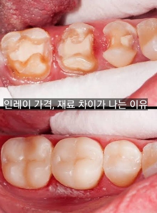 인레이 가격, 재료에 따라 차이가 나는 이유