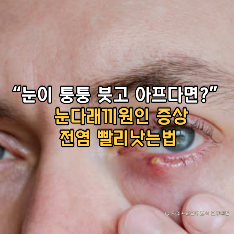“눈이 퉁퉁 붓고 아프다면?” 눈다래끼원인 증상 전염 빨리낫는법
