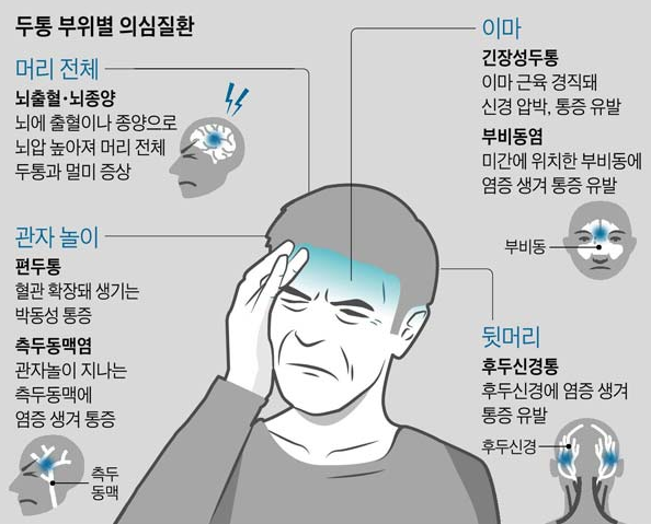 두통 원인, 부위별로 다릅니다! 뇌출혈 신호 구분법과 두통약 선택 가이드
