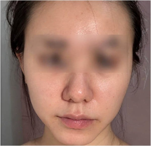 오메가3 여드름 두 달 챙긴 이야기