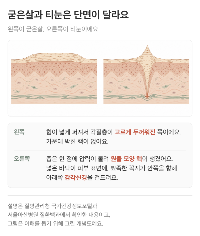 티눈 굳은살 사마귀 차이, 발바닥이 딱딱해졌을 때 구별하는 법