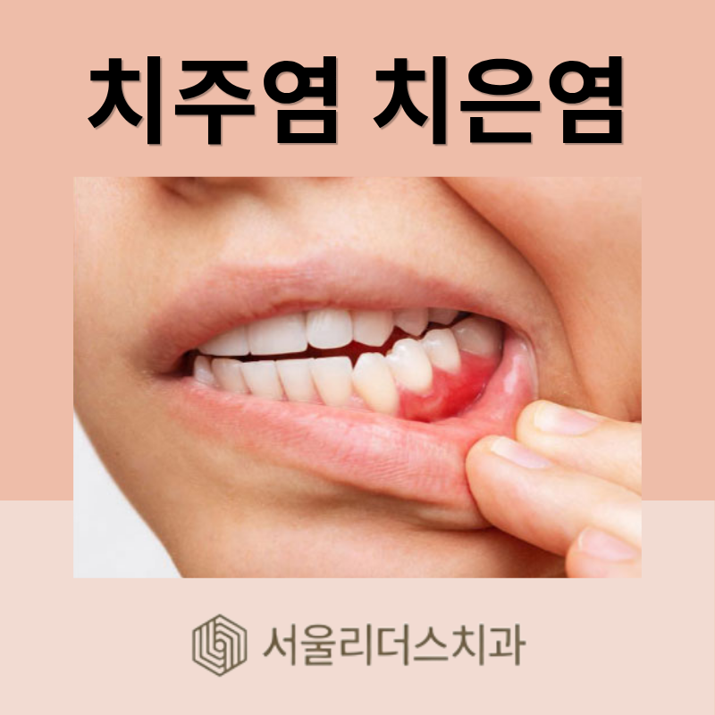 치주염 치은염 차이, 모르면 잇몸뼈 녹은 뒤 후회합니다
