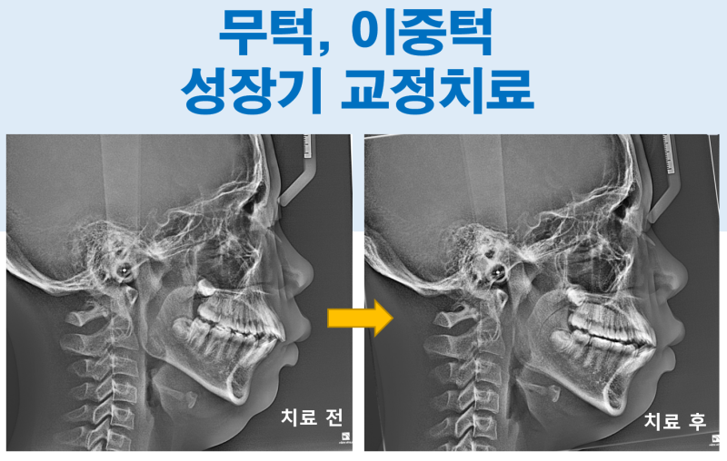 성장기 무턱 교정, Twin Block으로 하악 성장을 유도한 증례