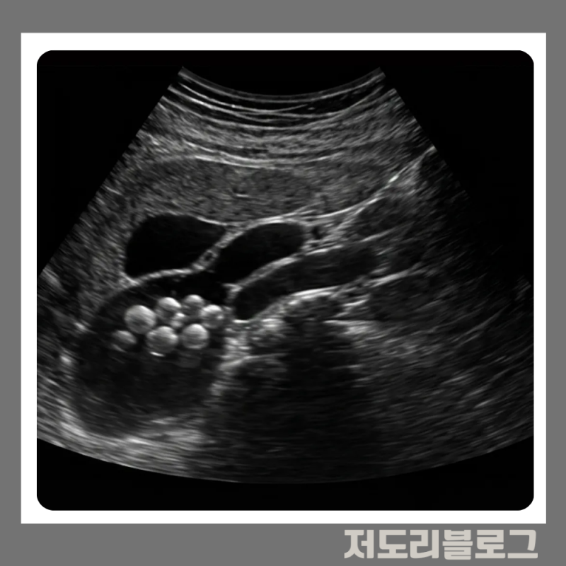 담석증 생기면 무조건 쓸개를 떼야 할까요? 수술 안해도 되는 기준 2가지