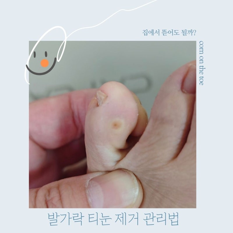 발가락 티눈 제거, 집에서 뜯어도 될까 원인부터 안전한 관리법까지