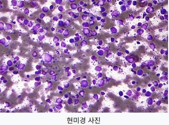 "혈액암 재발을 반복하던 어느 환자" 마지막 치료가 바꾼 결과